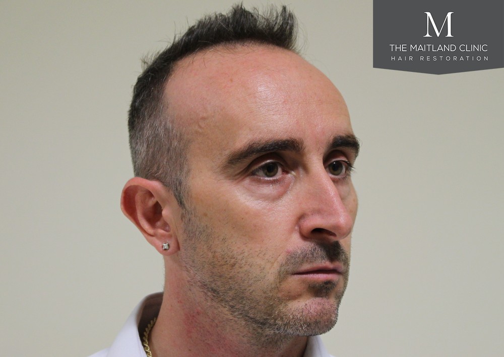 3487 grafts by FUE over 2 procedures
