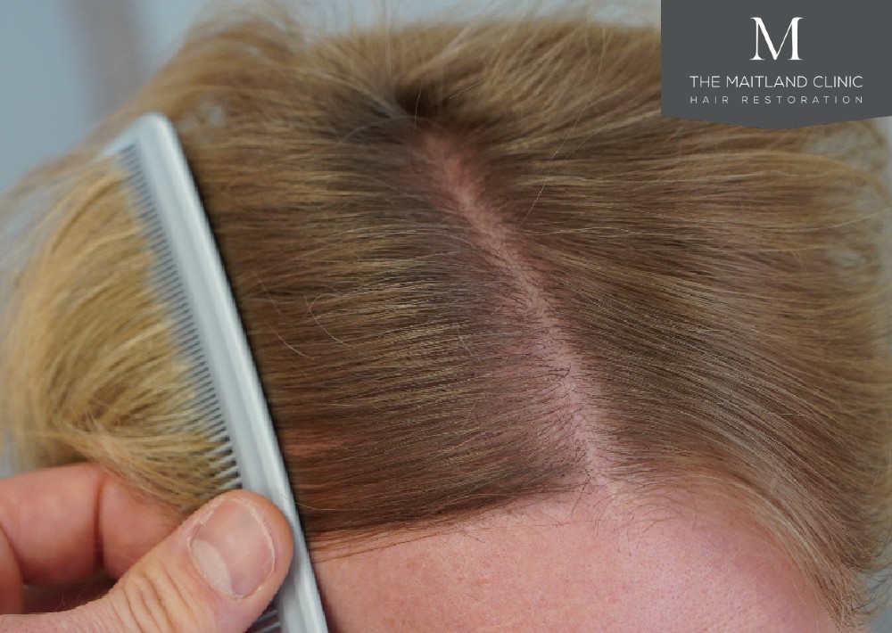 1800 grafts by FUE