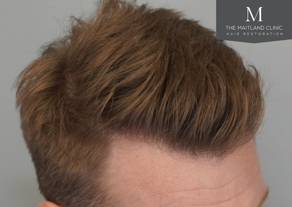 1204 grafts by FUE