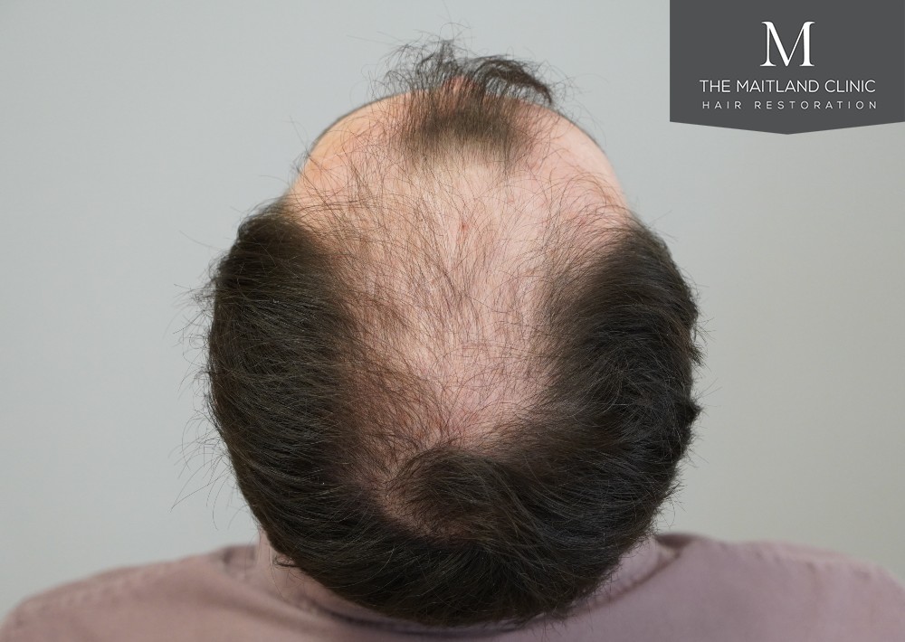 2083 graft by FUE