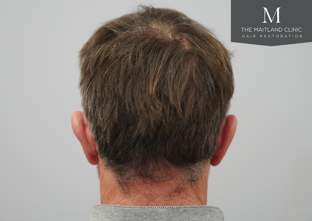 1725 grafts by FUE