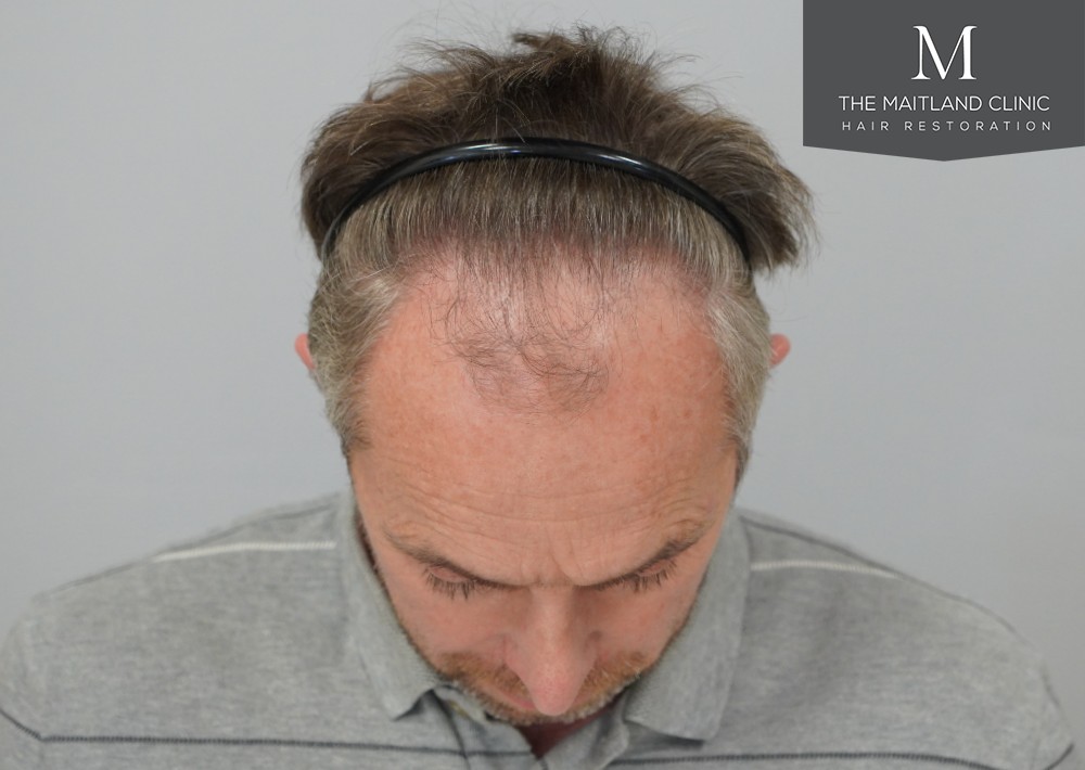 1725 grafts by FUE