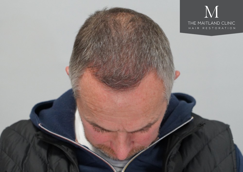 1725 grafts by FUE