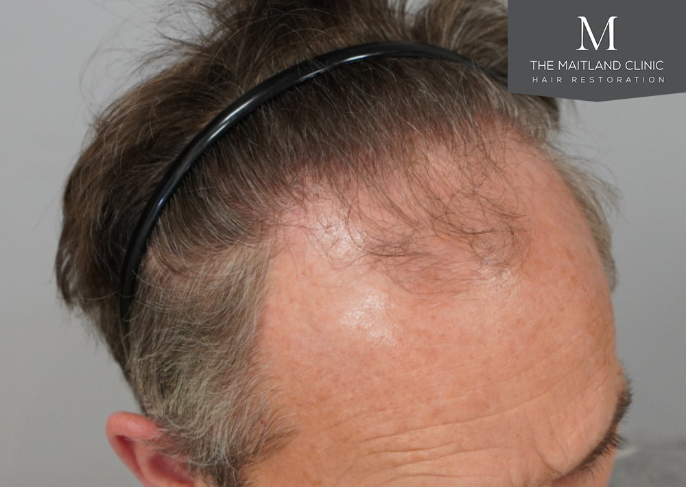 1725 grafts by FUE