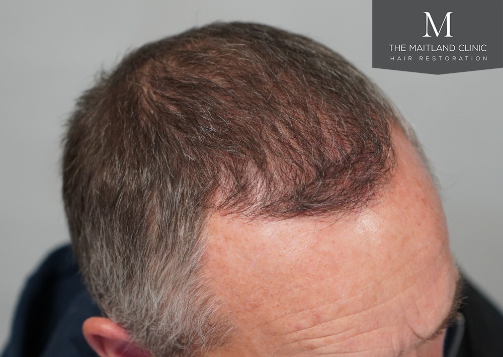 1725 grafts by FUE