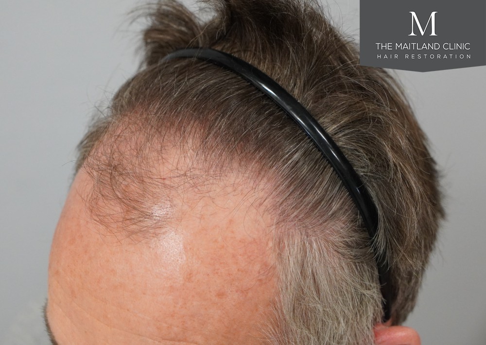 1725 grafts by FUE