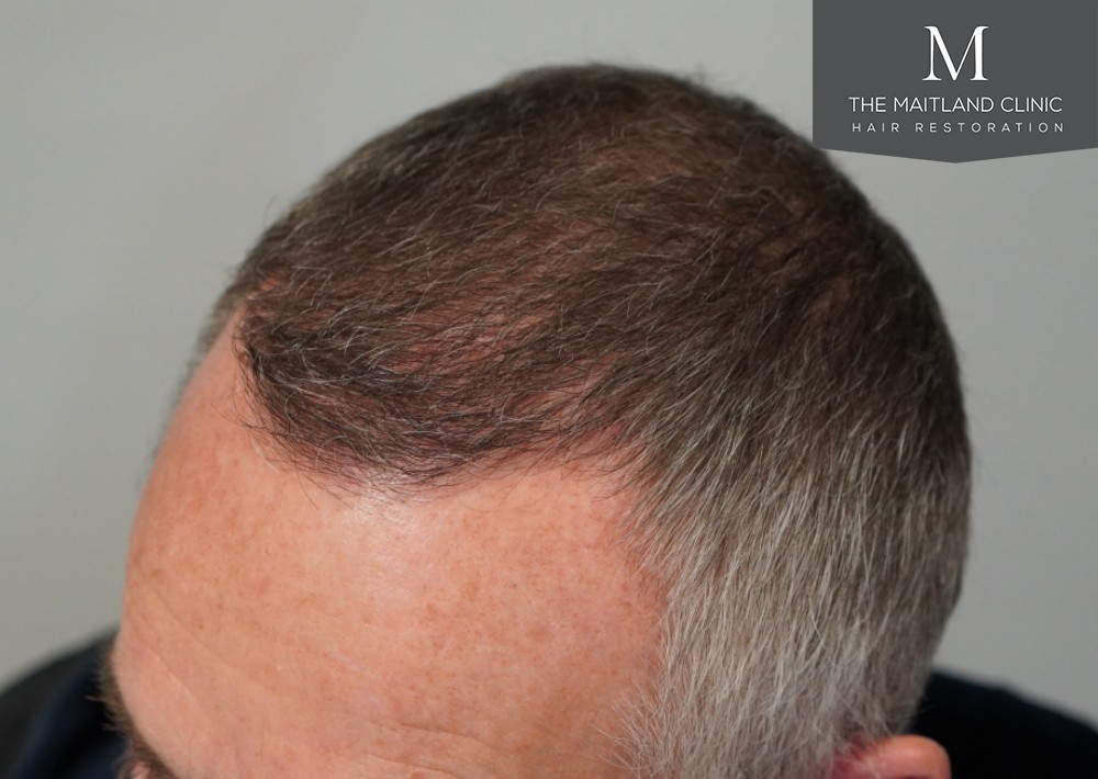 1725 grafts by FUE