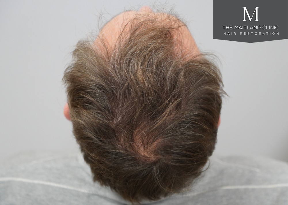 1725 grafts by FUE