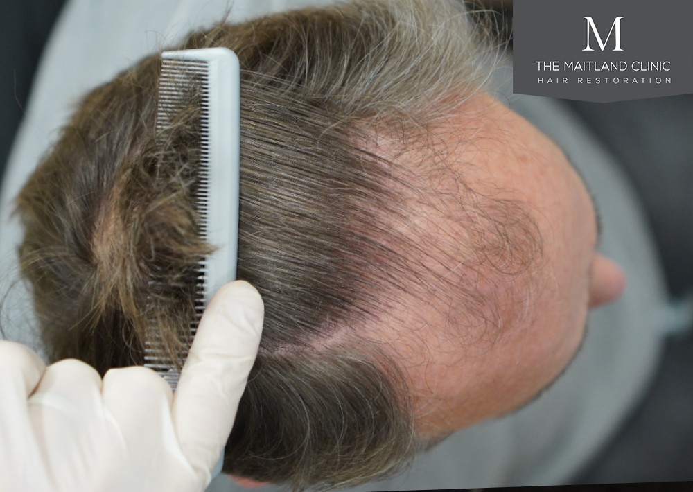 1725 grafts by FUE