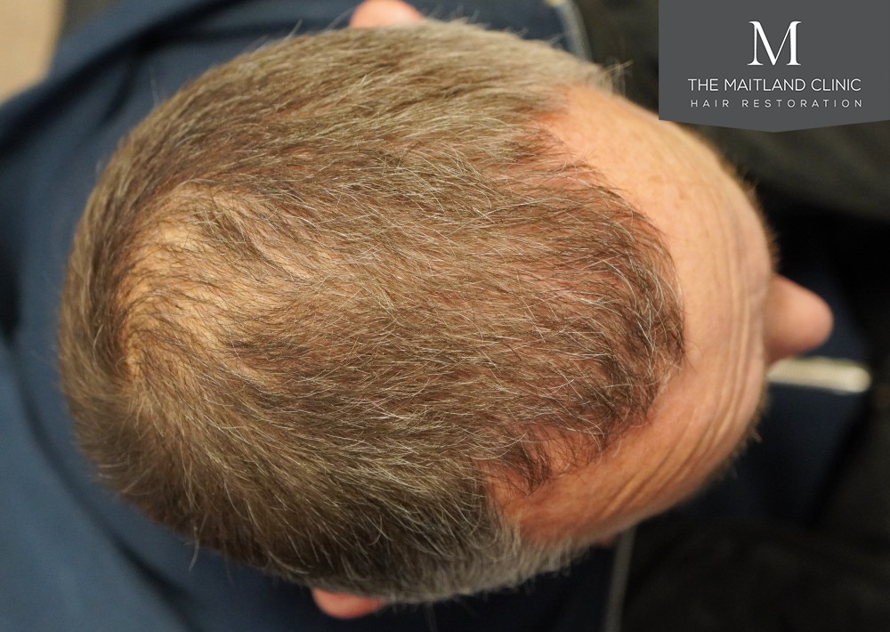 1725 grafts by FUE