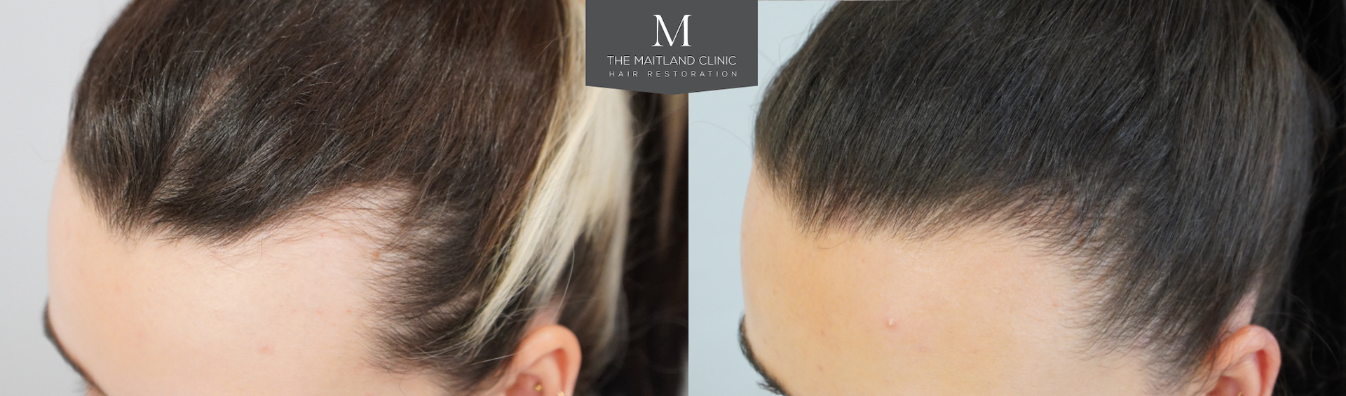 Side-by-side images showing hair restoration progress, with a noticeably fuller hairline in the right image