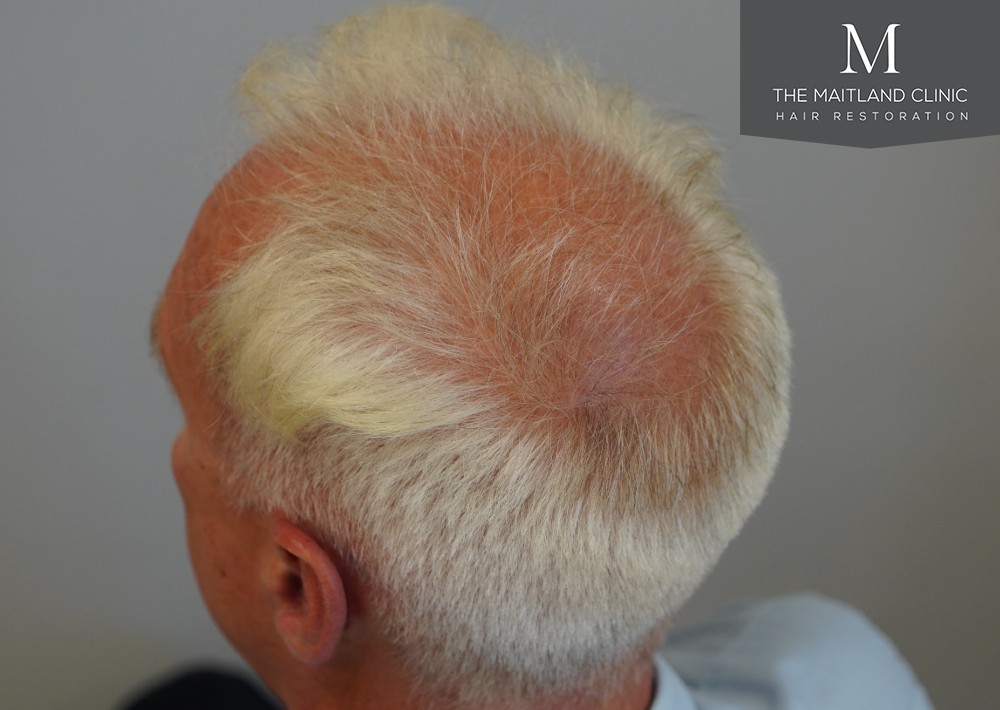 2280 grafts by FUE