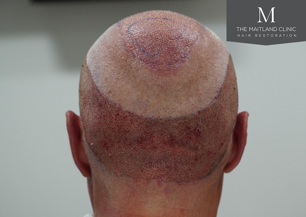 2280 grafts by FUE
