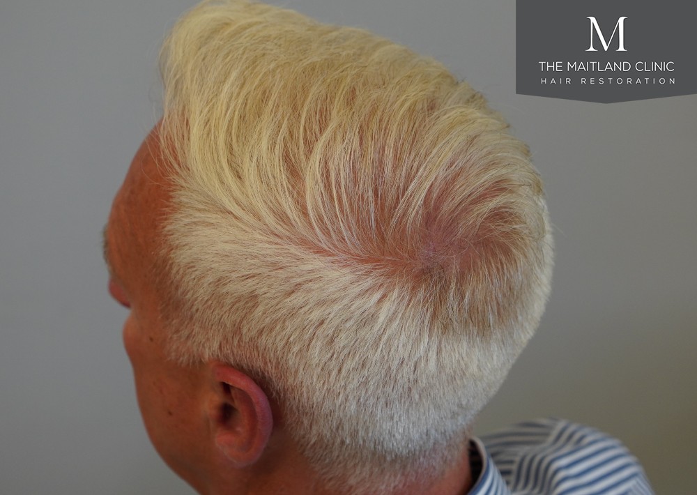 2280 grafts by FUE