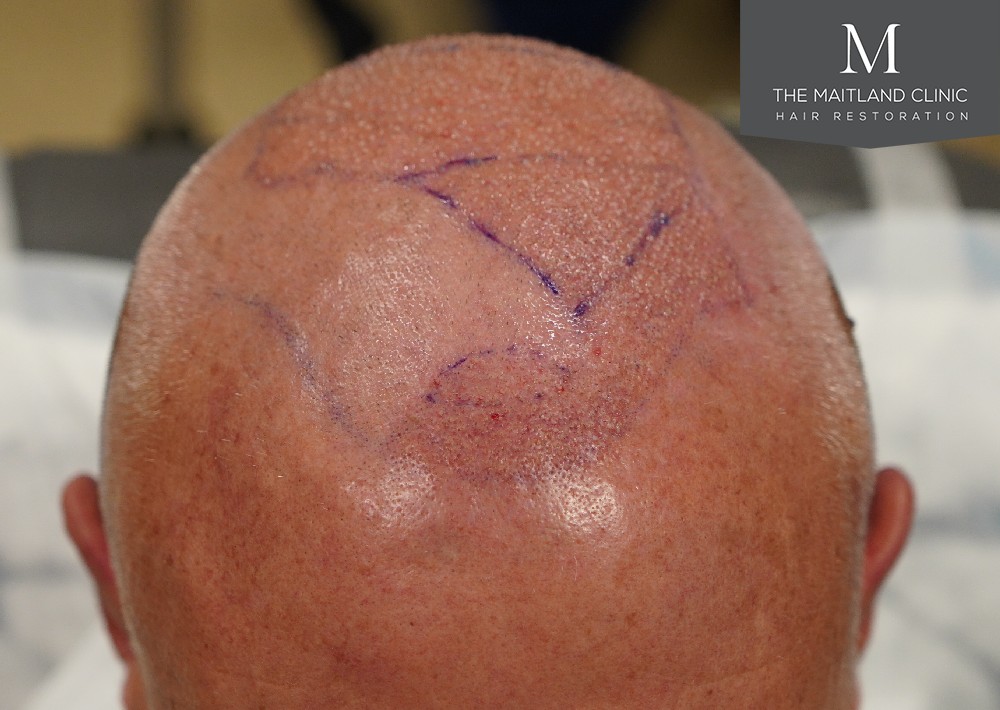 2280 grafts by FUE