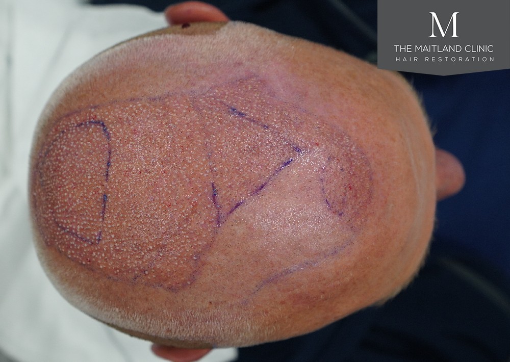 2280 grafts by FUE