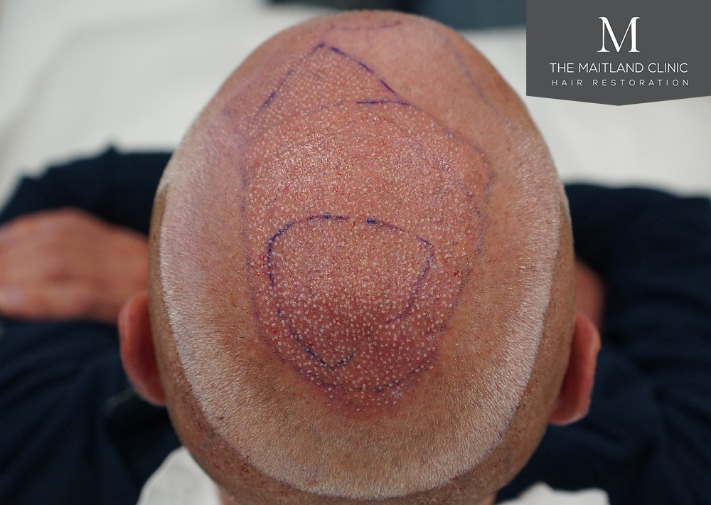 2280 grafts by FUE