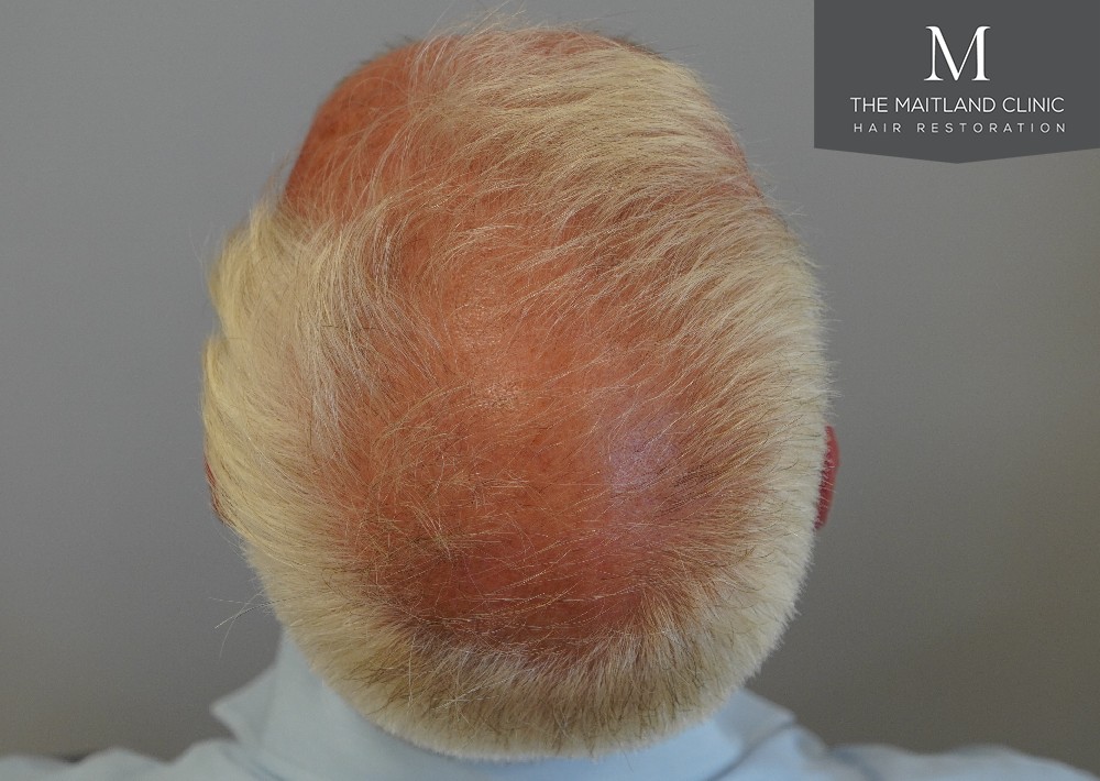 2280 grafts by FUE
