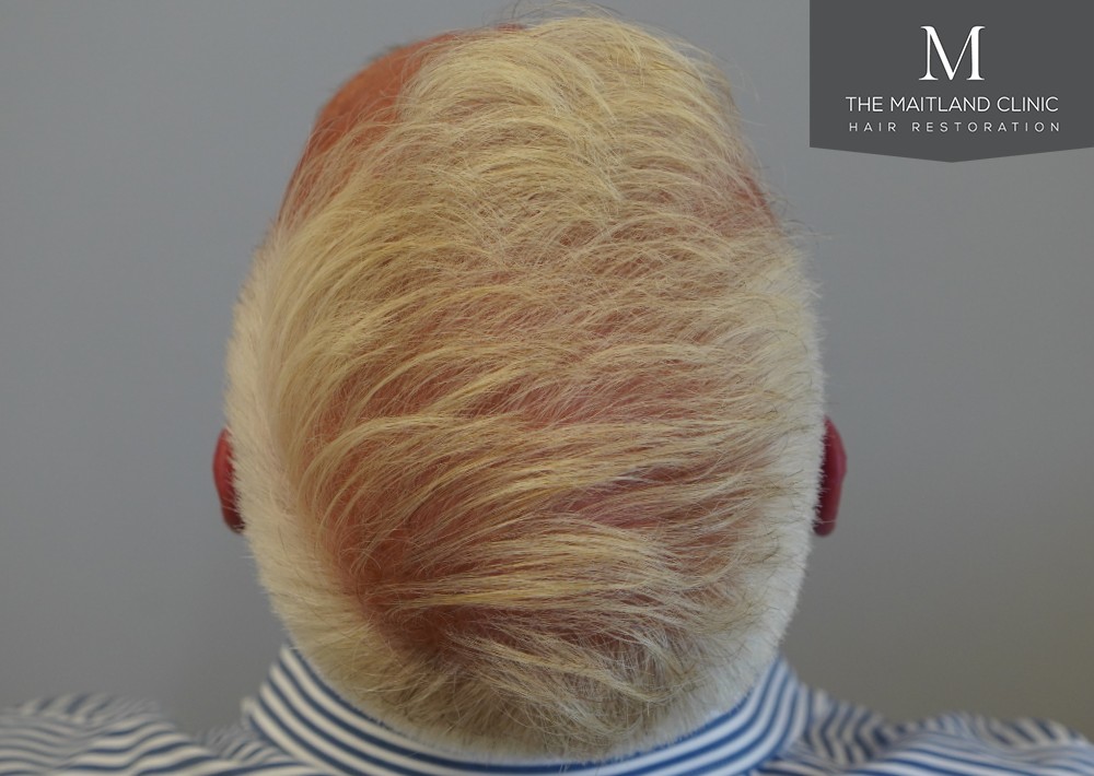 2280 grafts by FUE