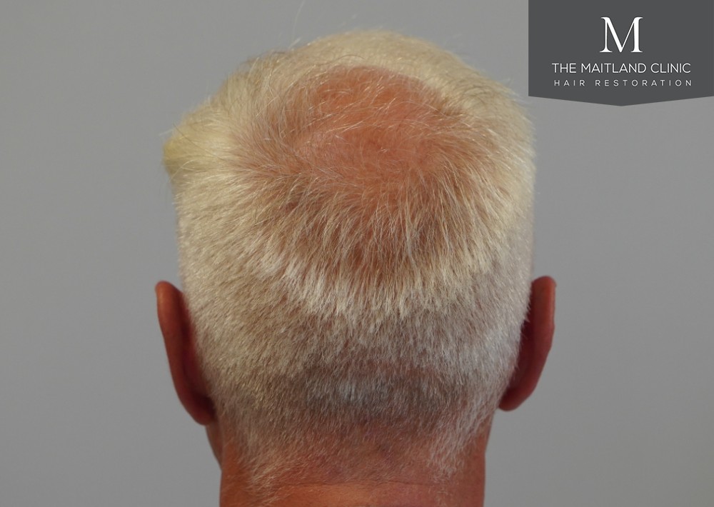 2280 grafts by FUE
