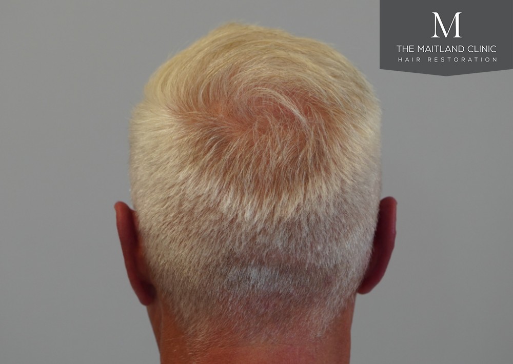 2280 grafts by FUE