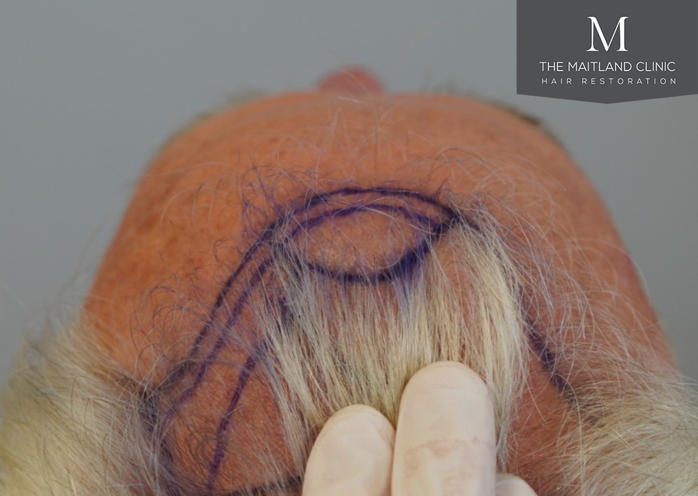 2280 grafts by FUE