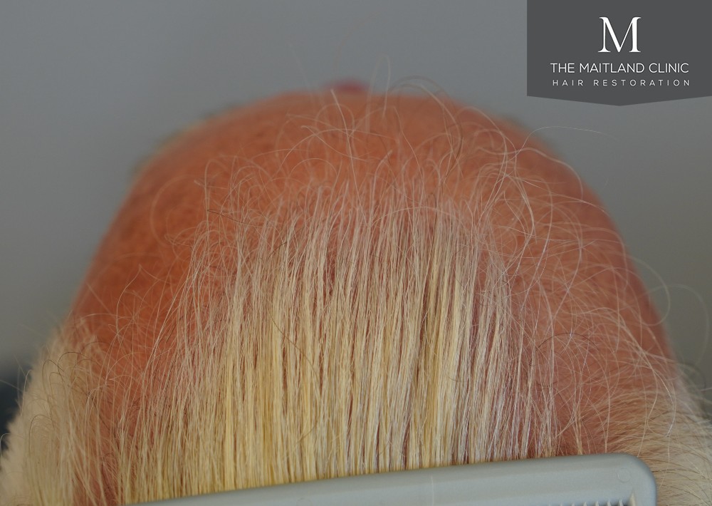 2280 grafts by FUE
