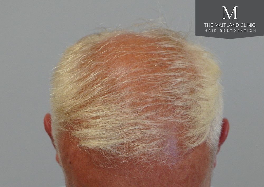 2280 grafts by FUE