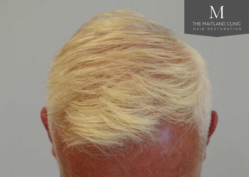 2280 grafts by FUE