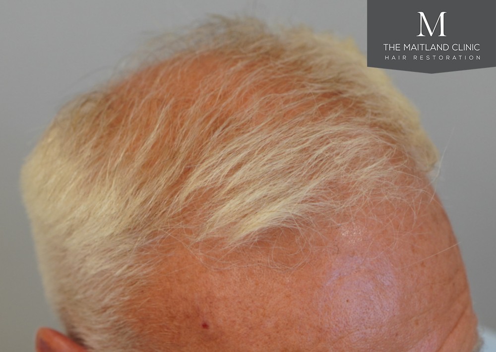 2280 grafts by FUE