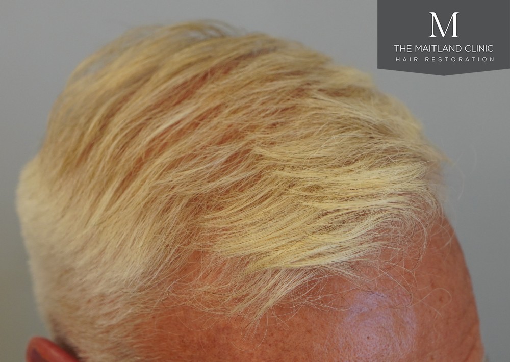 2280 grafts by FUE