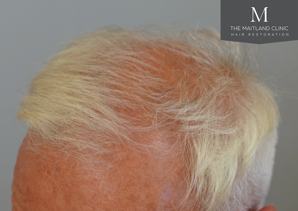 2280 grafts by FUE