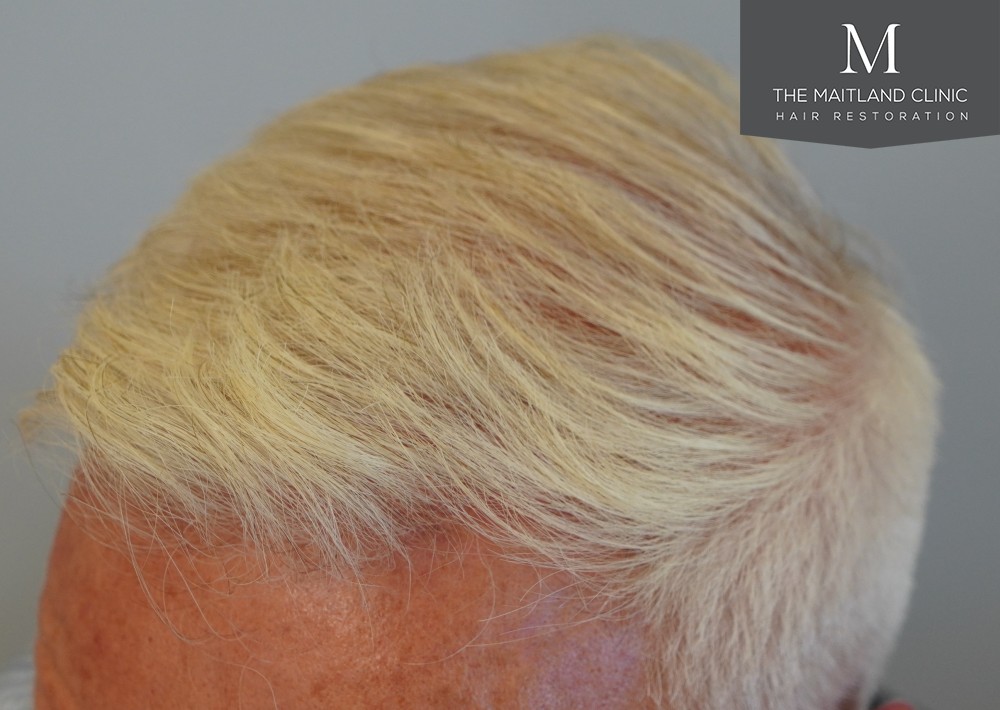 2280 grafts by FUE