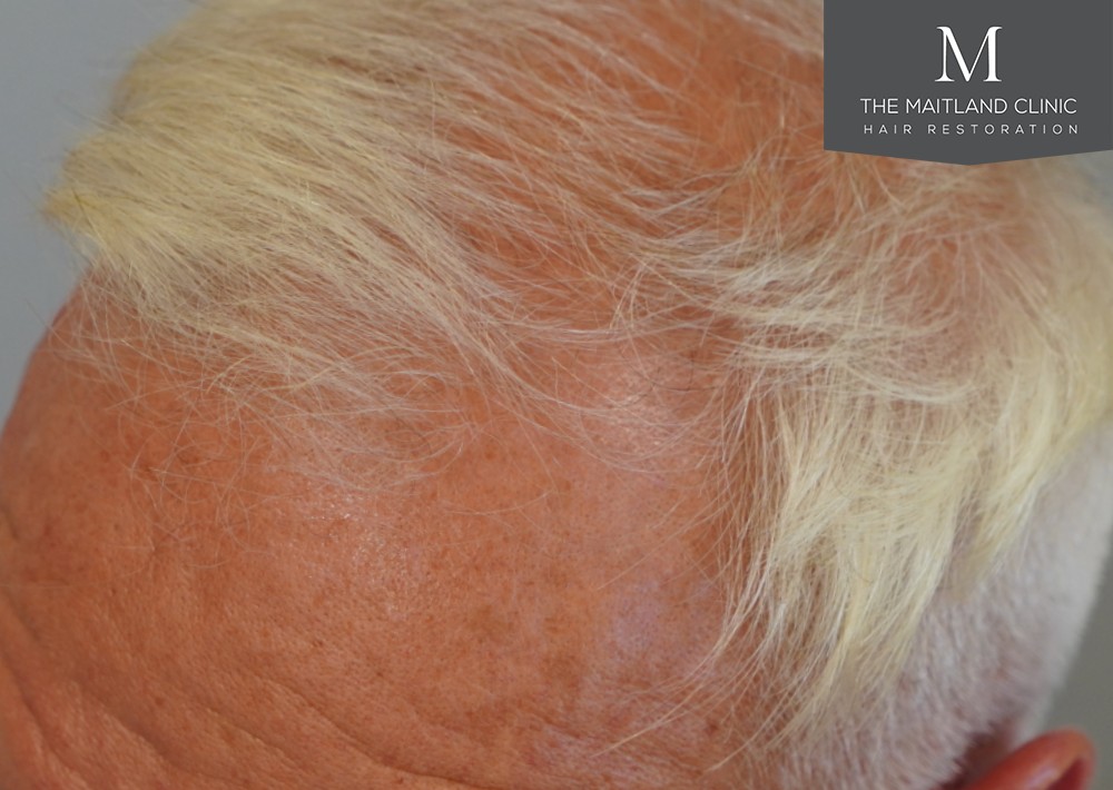 2280 grafts by FUE