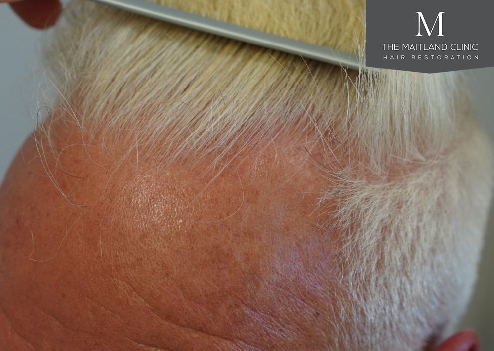 2280 grafts by FUE