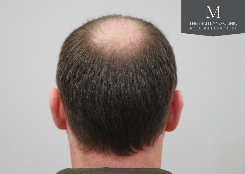 2468 grafts by FUE