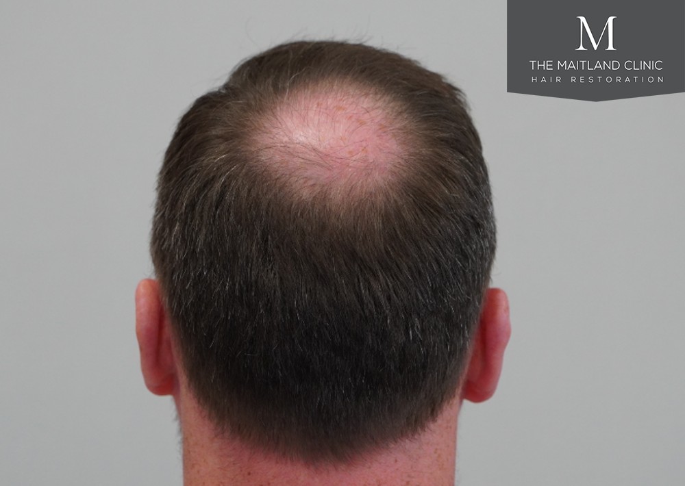 2468 grafts by FUE