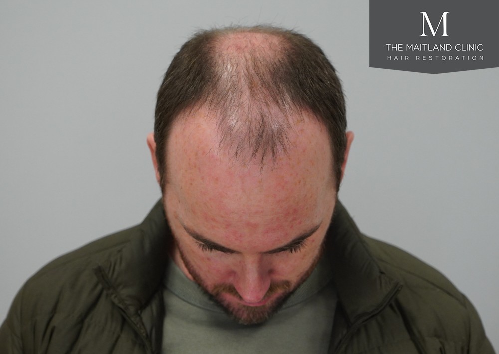 2468 grafts by FUE