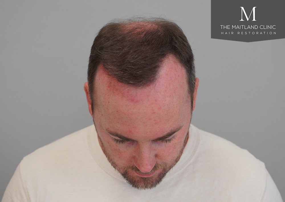 2468 grafts by FUE