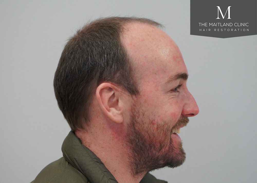 2468 grafts by FUE
