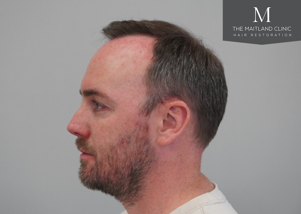 2468 grafts by FUE