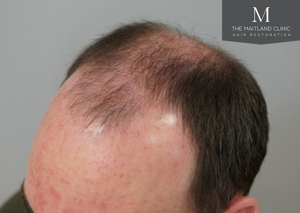 2468 grafts by FUE