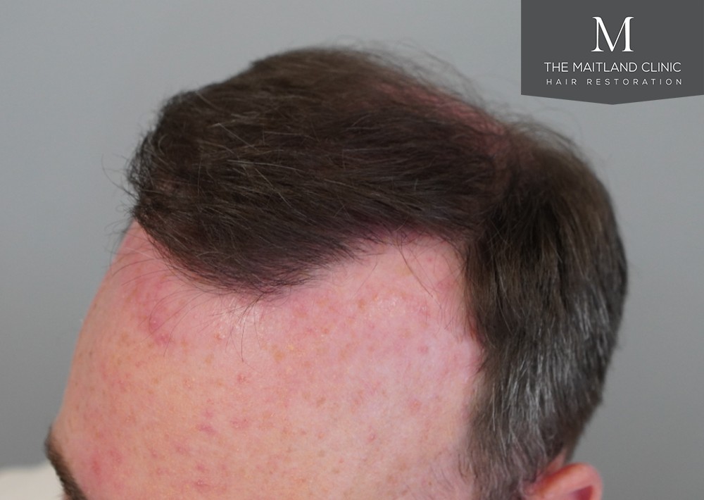 2468 grafts by FUE