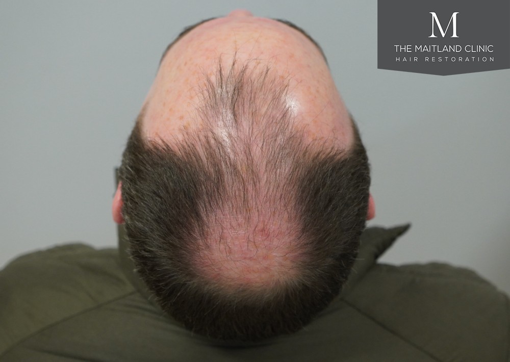 2468 grafts by FUE