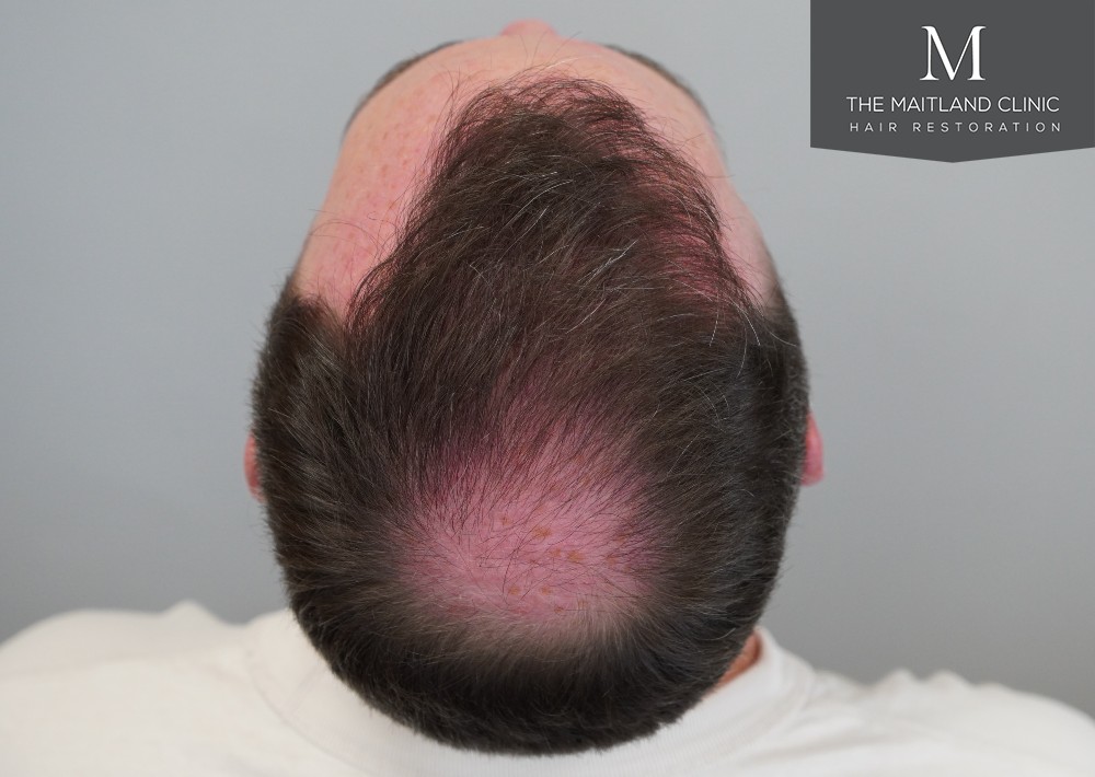 2468 grafts by FUE