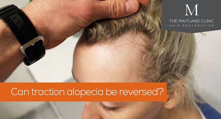 Can Traction Alopecia be reversed?