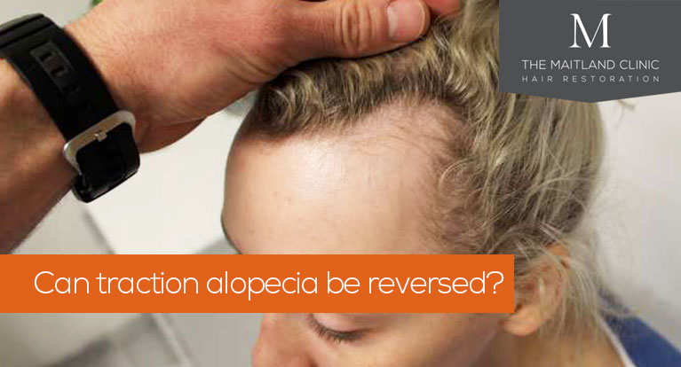 Can traction alopecia be reversed