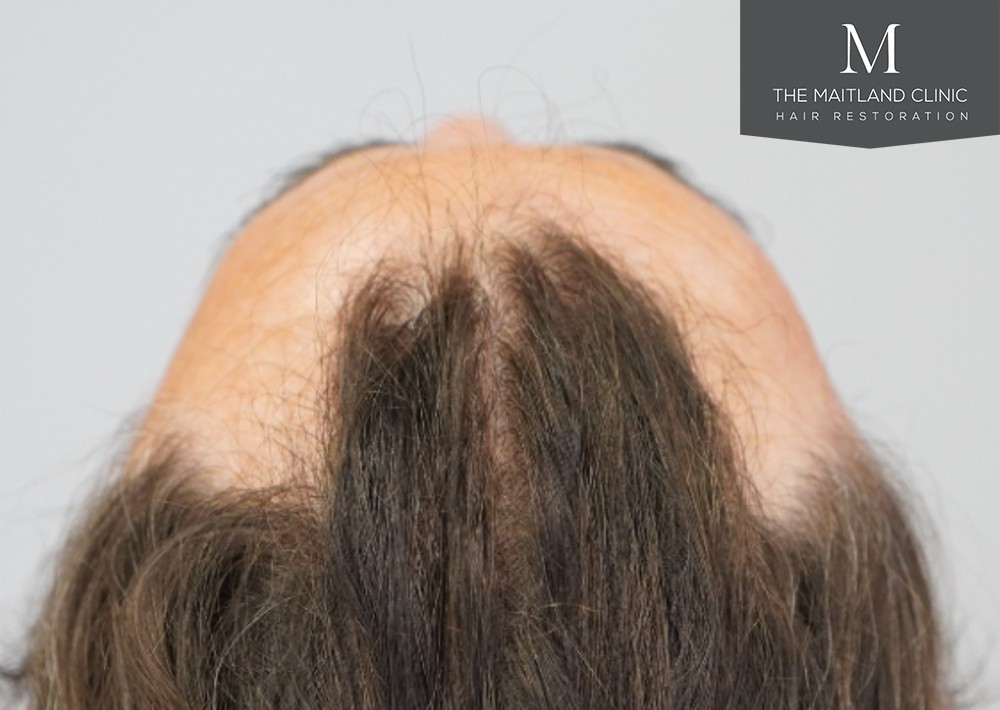2571 grafts by FUT