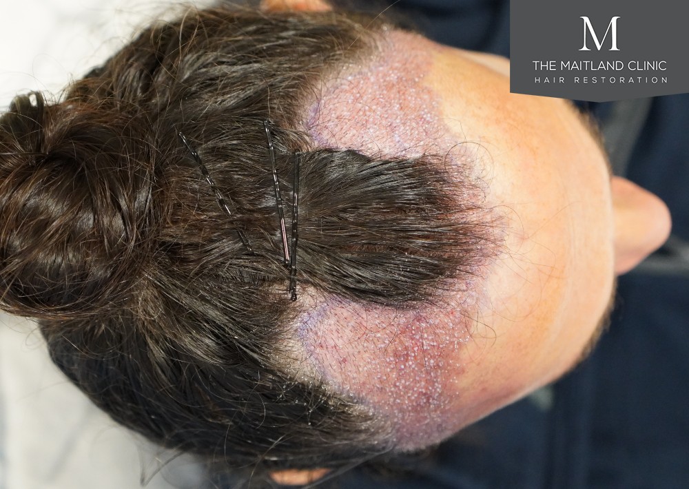 2571 grafts by FUT