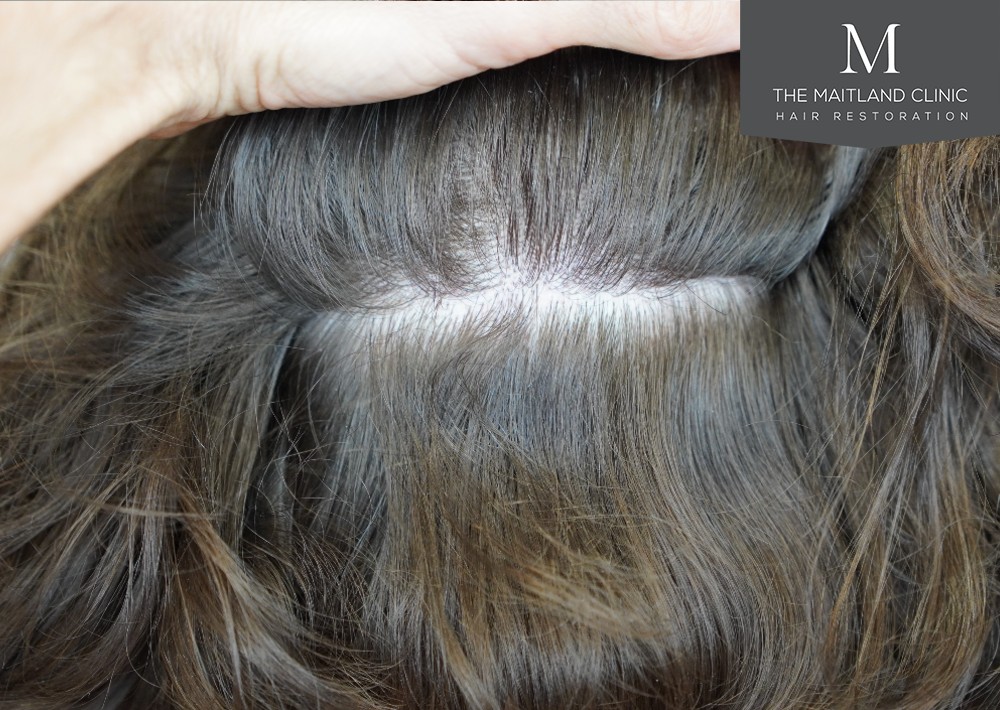2571 grafts by FUT